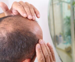 What Are the Total Costs of a Hair Transplant? Beyond the Surgery